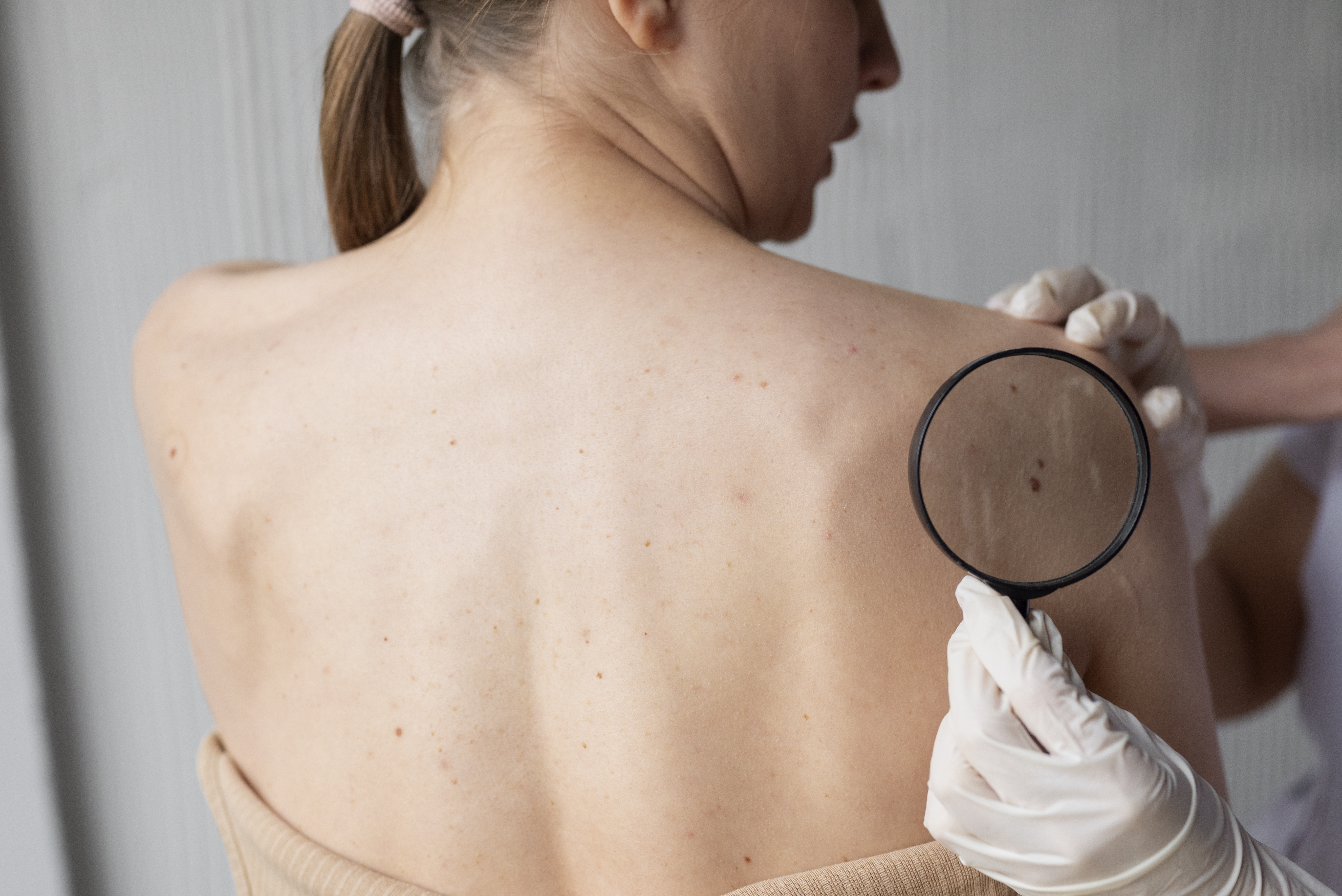 Cáncer de piel: especialistas advierten que el daño solar comienza desde la infancia